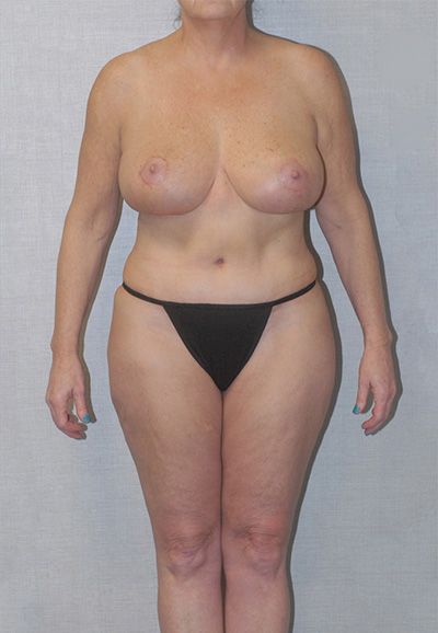 Liposuction Before & After
