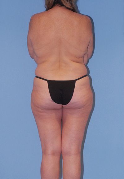 Liposuction Before & After