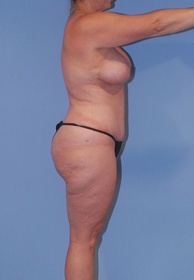 Liposuction Before & After