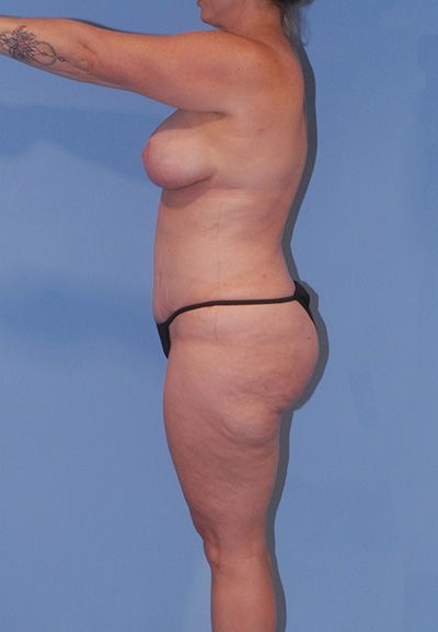 Liposuction Before & After