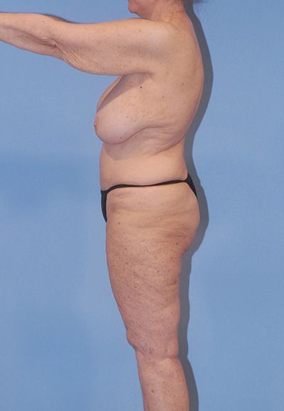 Liposuction Before & After
