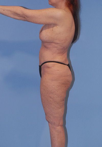 Liposuction Before & After