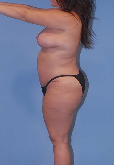 Liposuction Before & After