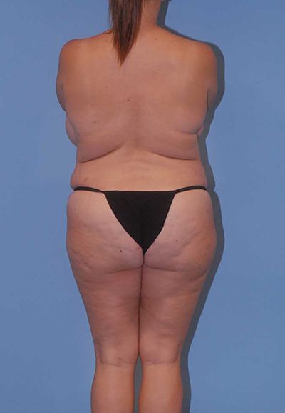 Liposuction Before & After