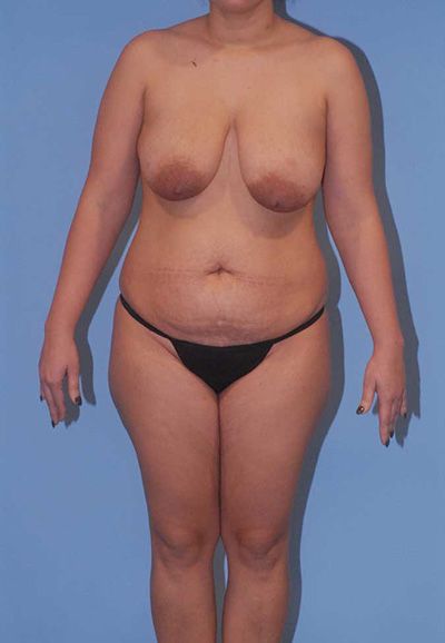 Liposuction Before & After