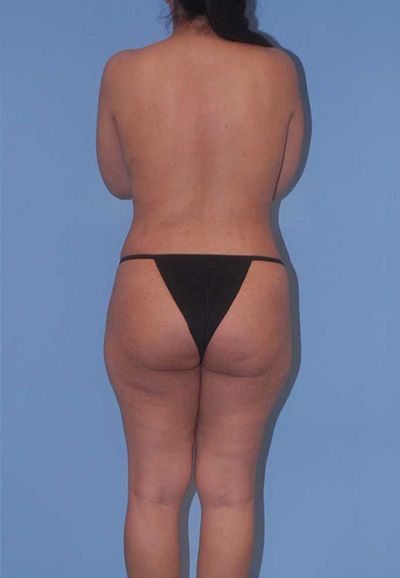 Liposuction Before & After
