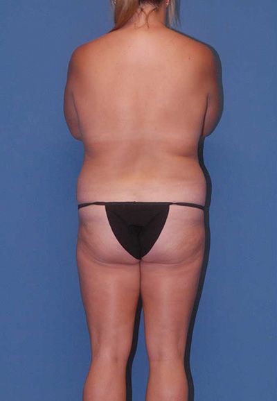 Liposuction Before & After