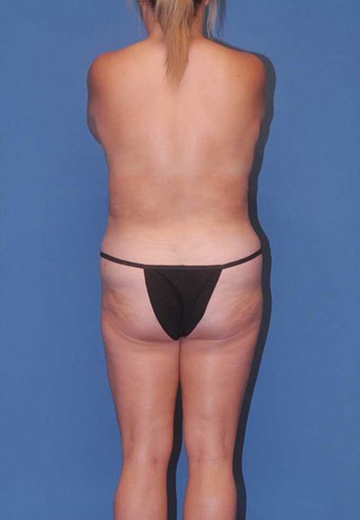 Liposuction Before & After