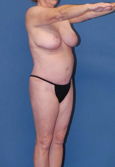 Liposuction Before & After