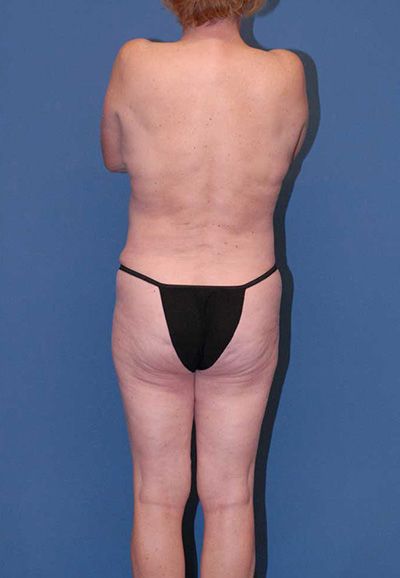 Liposuction Before & After