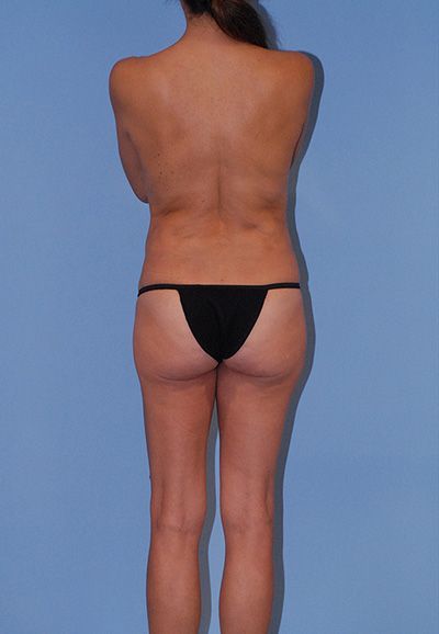 Liposuction Before & After