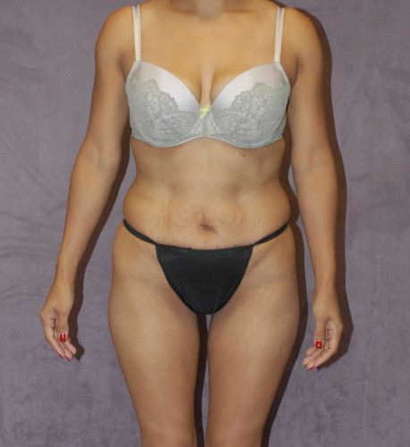 Liposuction Before & After