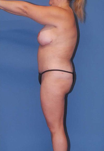Liposuction Before & After