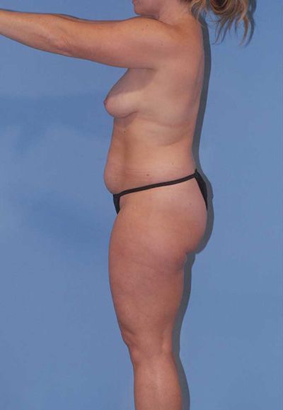 Liposuction Before & After