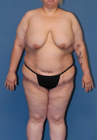 Liposuction Before & After