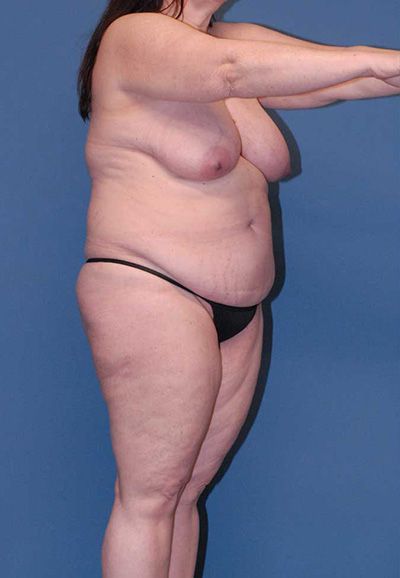 Liposuction Before & After