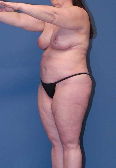 Liposuction Before & After