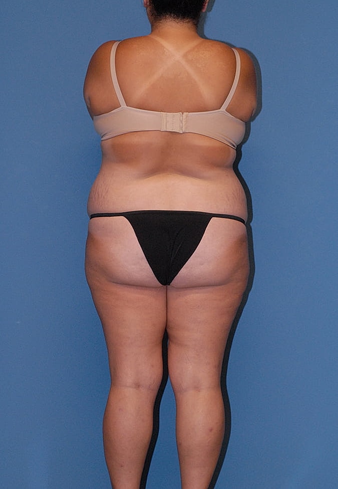 Liposuction Before & After