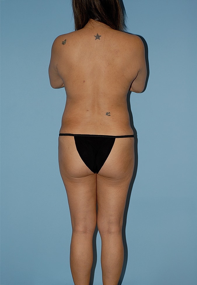 Liposuction Before & After