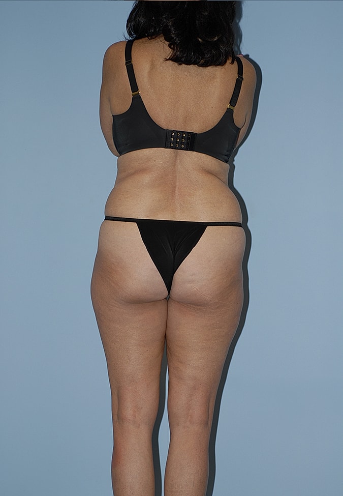 Liposuction Before & After