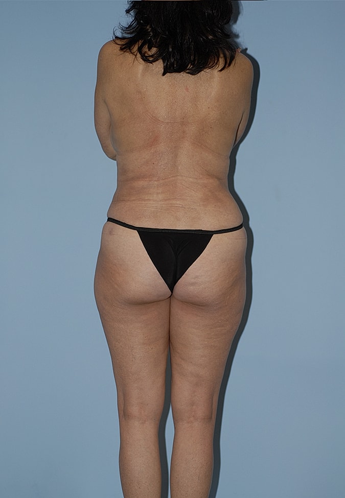Liposuction Before & After