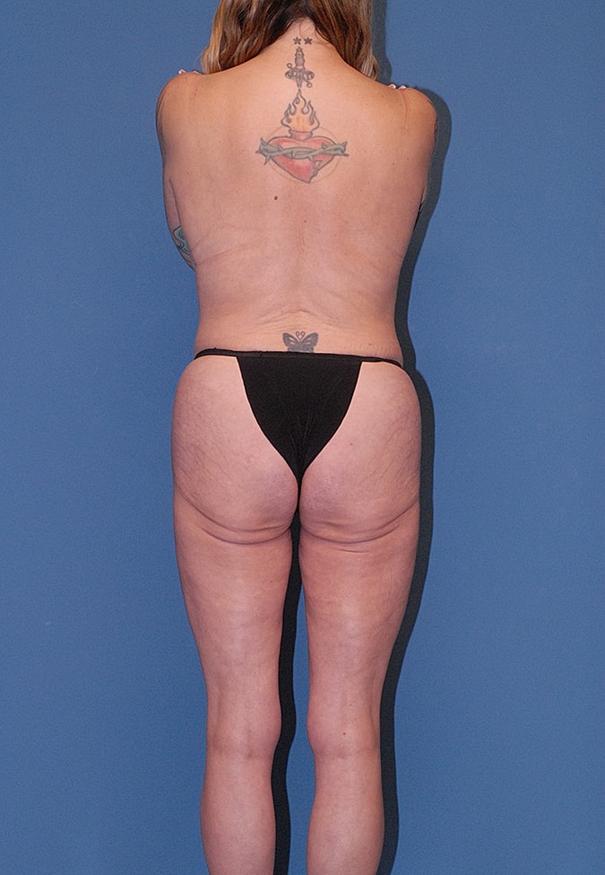 Liposuction Before & After