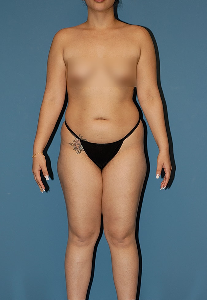 Liposuction Before & After