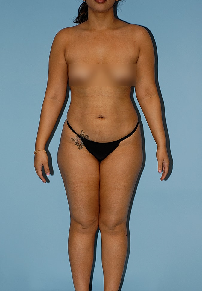 Liposuction Before & After