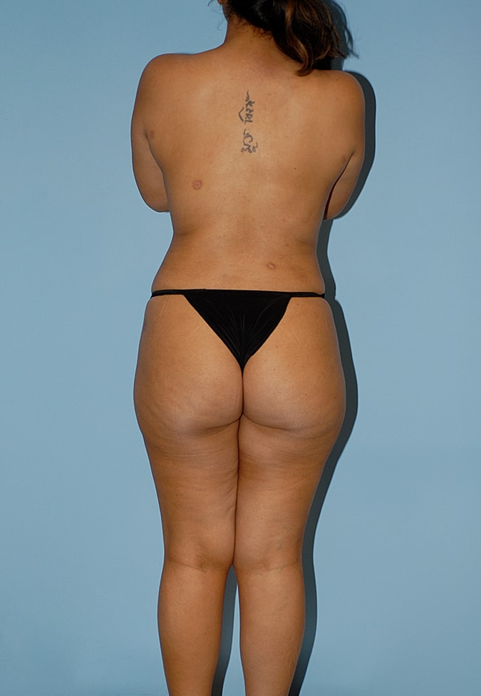 Liposuction Before & After