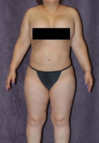 Liposuction Before & After