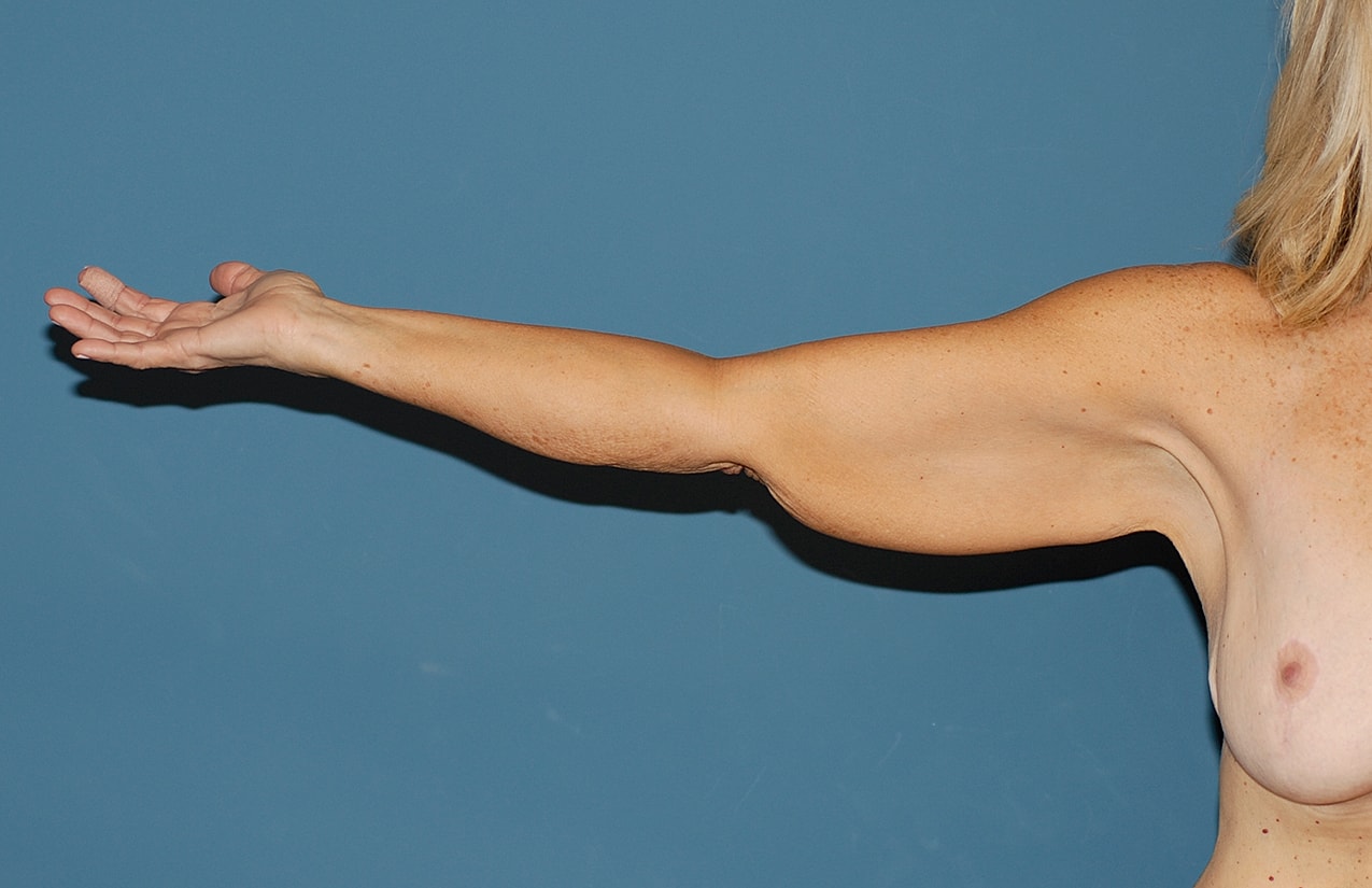 Liposuction Before & After
