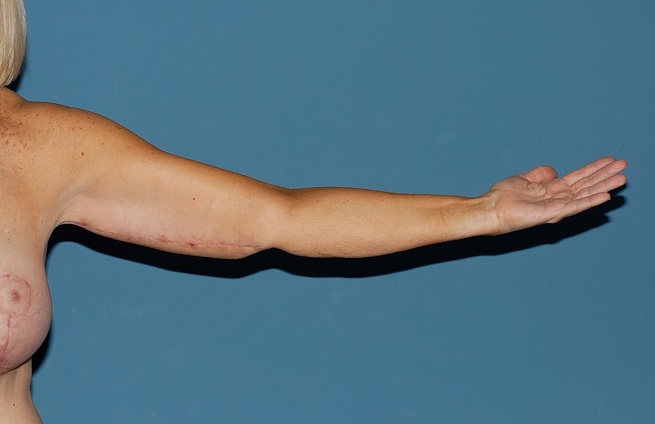 Liposuction Before & After
