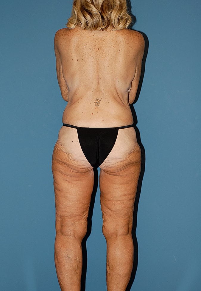 Liposuction Before & After