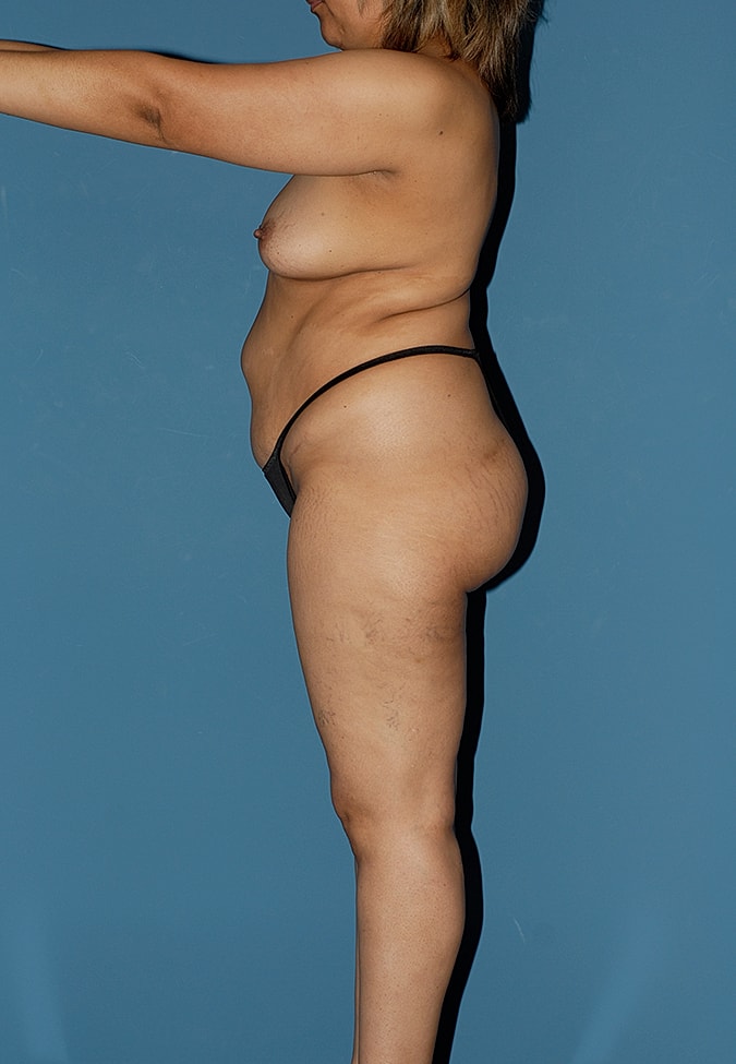 Liposuction Before & After