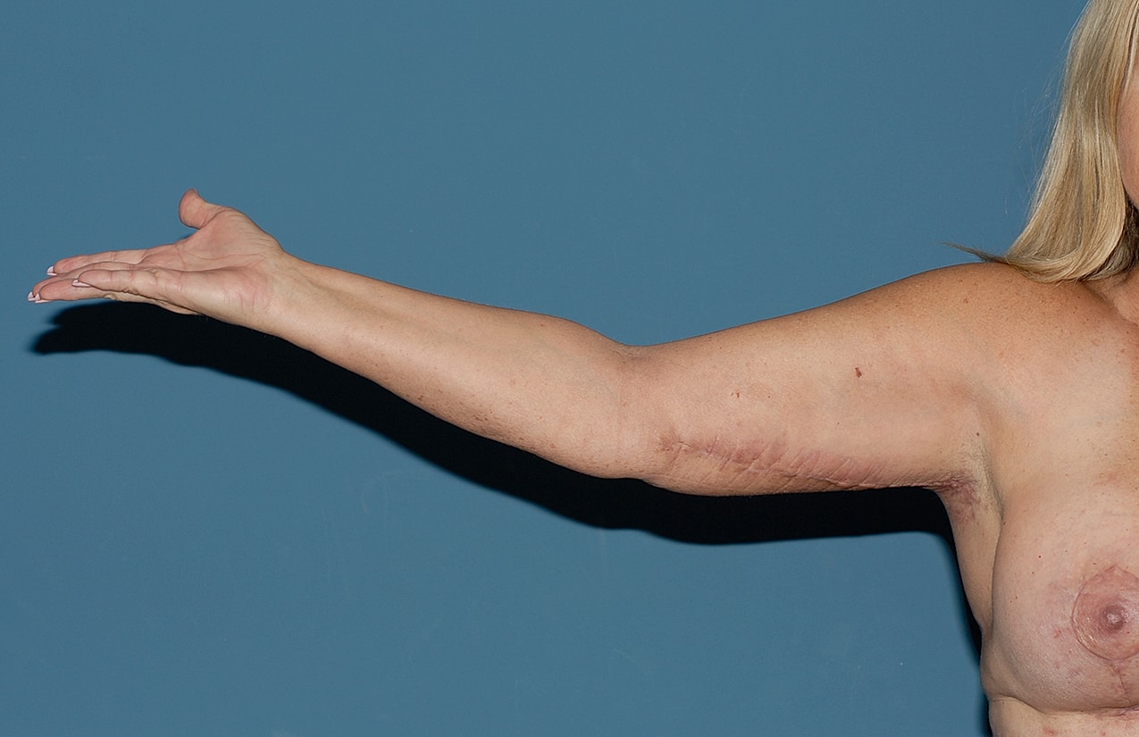 Liposuction Before & After