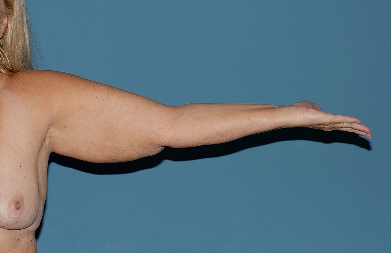 Liposuction Before & After