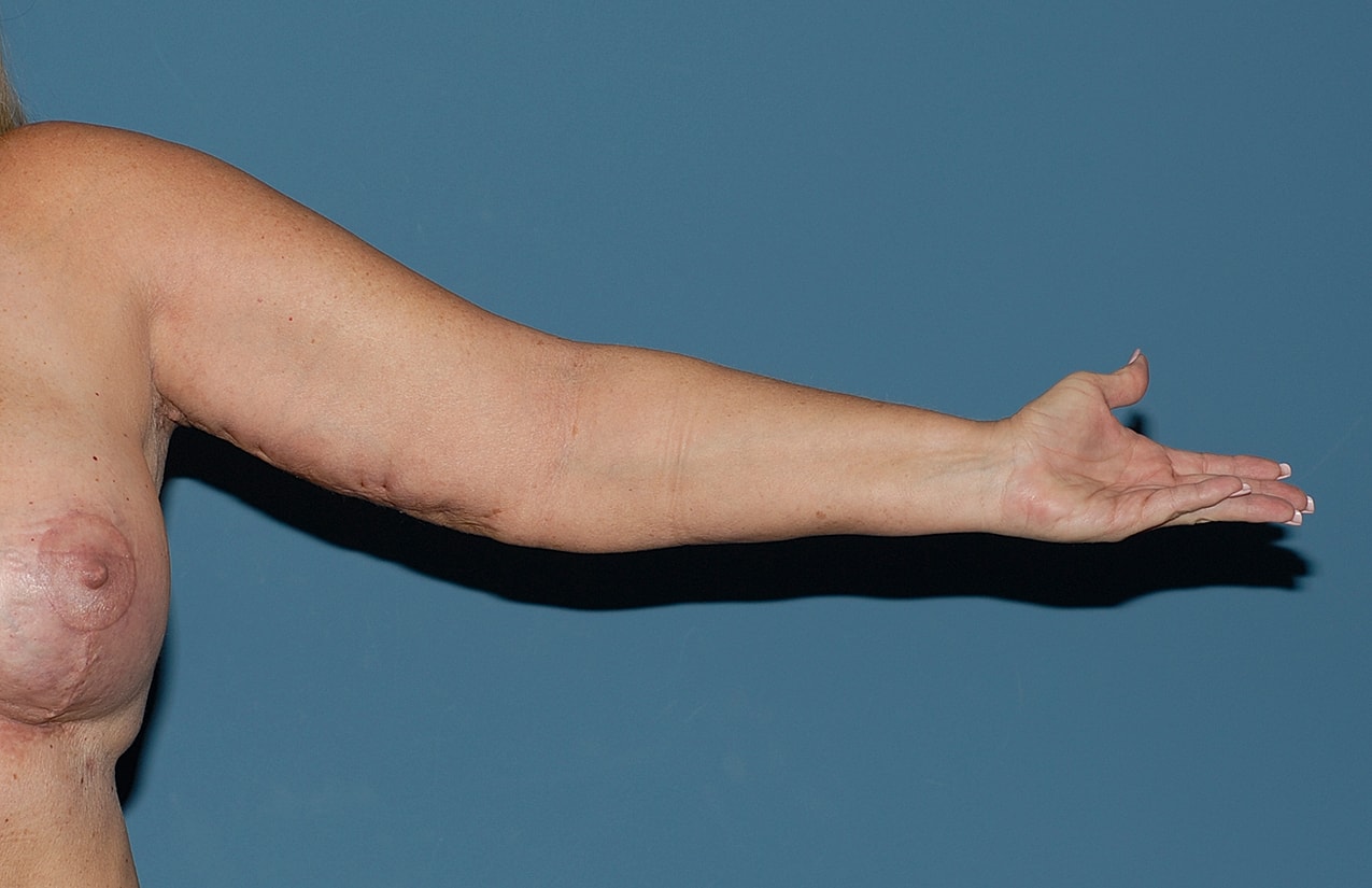 Liposuction Before & After