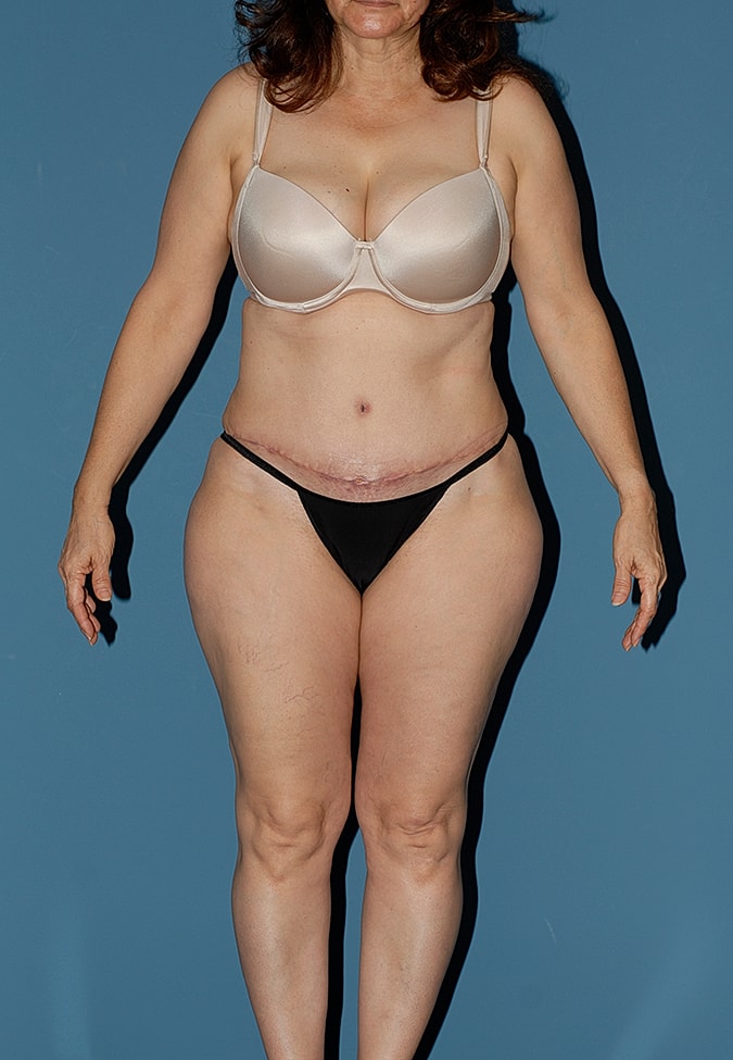 Liposuction Before & After