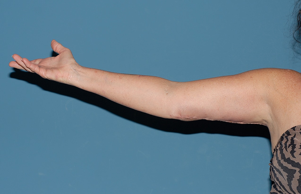 Liposuction Before & After