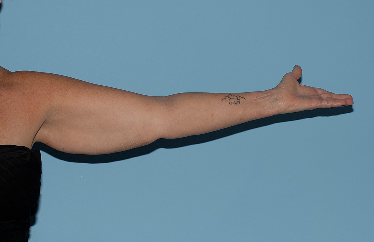 Liposuction Before & After