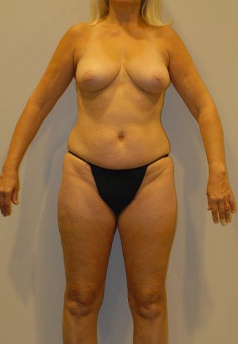 Liposuction Before & After