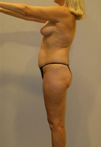 Liposuction Before & After