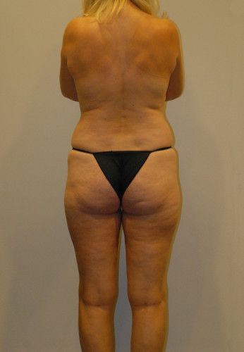 Liposuction Before & After