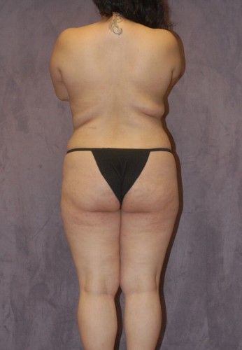 Liposuction Before & After