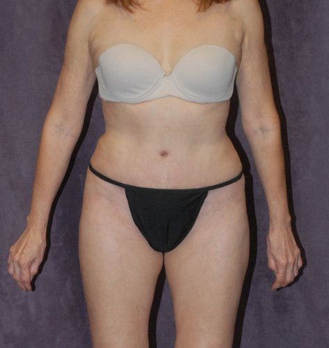 Liposuction Before & After