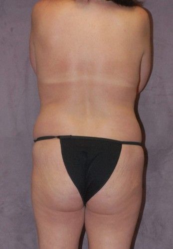 Liposuction Before & After