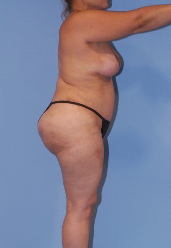 Liposuction Before & After