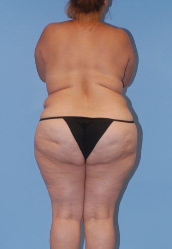 Liposuction Before & After