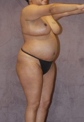 Liposuction Before & After