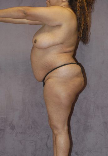 Liposuction Before & After